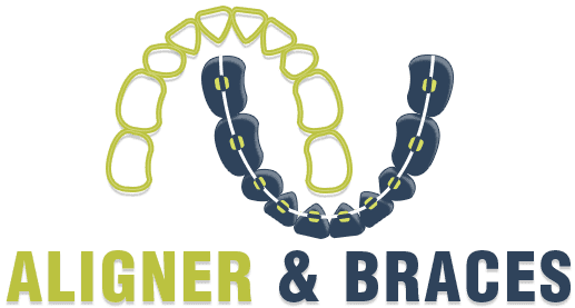 Aligner & Braces - Best Orthodontist & Dentist in Delhi